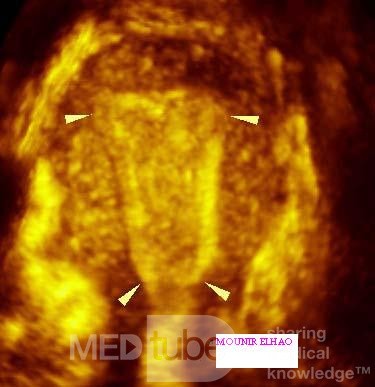 Gebärmutterhöhle (cavum uteri)-  3D-Sonografie