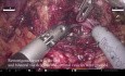 Nerverhaltende roboterassistierte radikale Prostatektomie (RARP) mit Erhalt der endopelvinen Faszie