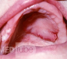 Fibrom des Gaumens
