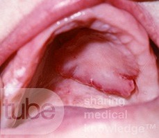 Fibrom des Gaumens