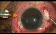 Behandlung der posttraumatischen Endophthalmitis