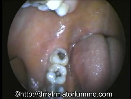 Untersuchung des Oropharynx