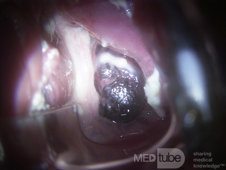 Dezidualpolyp