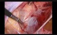 Ligation der Arteria uterina