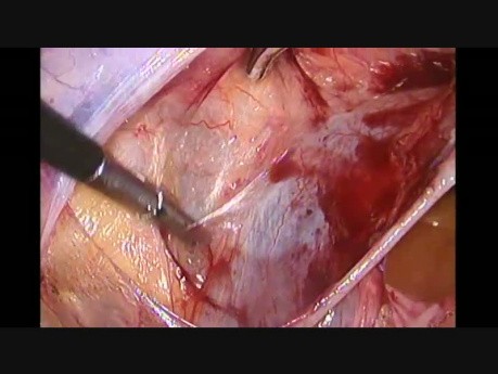 Ligation der Arteria uterina