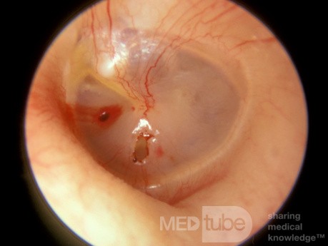 Linksseitige traumatische Trommelfellperforation
