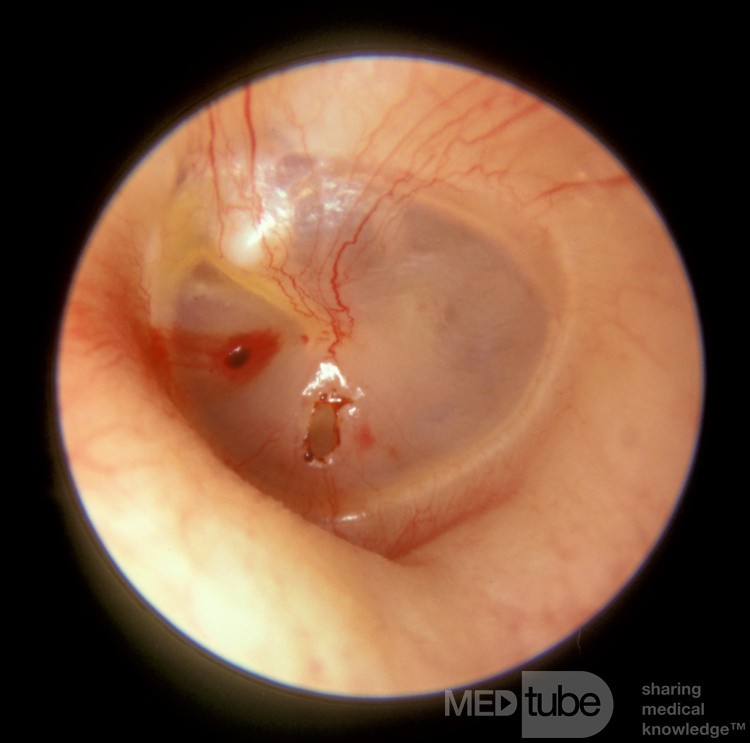 Linksseitige traumatische Trommelfellperforation