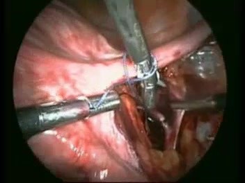 Ligatur beider Arteriae uterinae