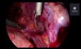 Chirurgie der tief-infiltrierenden Endometriose