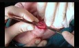 Plastische Chirurgie des Oberlids