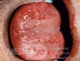 Atrophische Glossitis