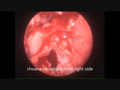 Endoskopische Choanalatresie-Reparatur