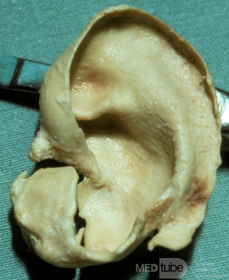 Ohrknorpel links