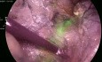 Totale Laparoskopische Hysterektomie (TLH) - ICG