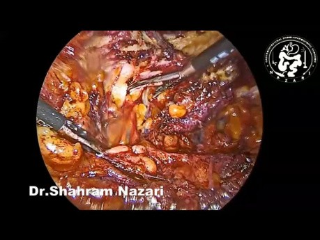 Bauchbruchchirurgie - Transversus abdominis release (TAR)