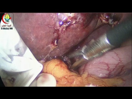 Entnahme von Lymphknoten