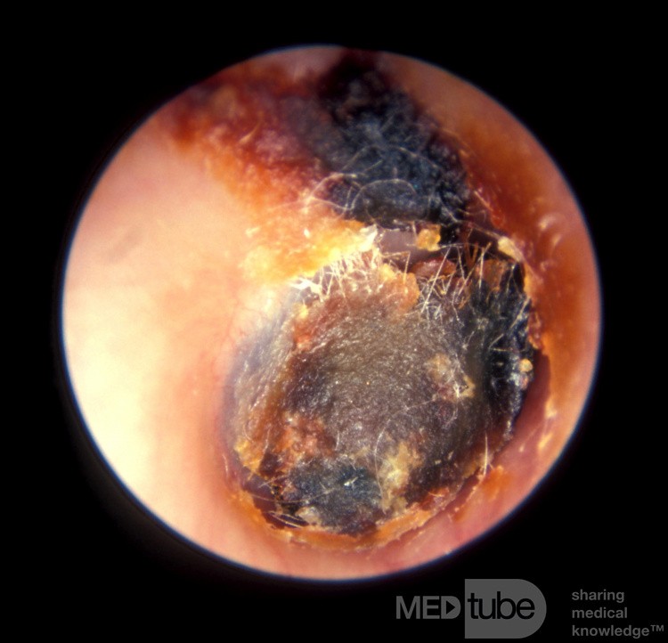Tief impaktiertes Cerumen - Wattestäbchen