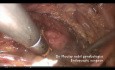 Uterus didelphys mit obstruierter Hemivagina und ipsilateraler Nierenagenesie (OHVIRA-Syndrom)