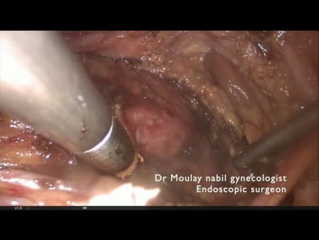 Uterus didelphys mit obstruierter Hemivagina und ipsilateraler Nierenagenesie (OHVIRA-Syndrom)