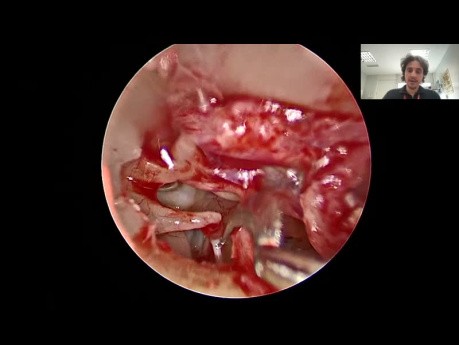 Endoskopische Stapedotomie mit Mikrobohrer bei Otosklerose