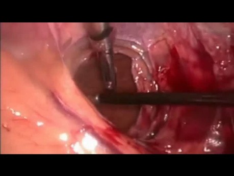 Adhäsiolyse vor der laparoskopischen Cholezystektomie