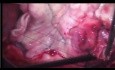 Bilaterale Herz- und Lungentransplantation