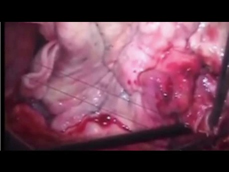 Bilaterale Herz- und Lungentransplantation