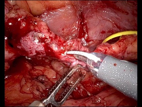 Ureteroplastik mit Buccamucosa-Transplantat unter Fluoreszenzführung
