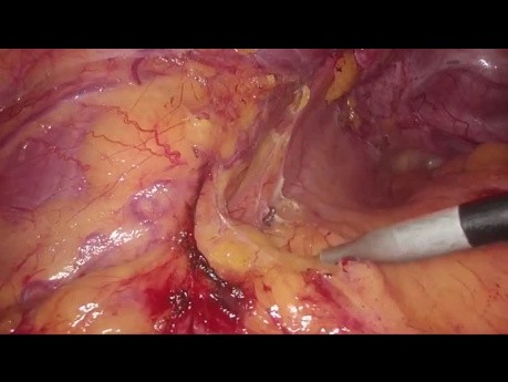 Arteria Moskowitz und Mobilisation der linken Flexur bei der laparoskopischen Sigmaresektion