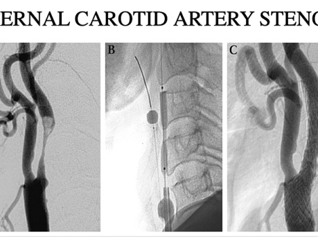 Vorlesung zum Thema Chirurgie der arteriellen Gefäßerkrankungen