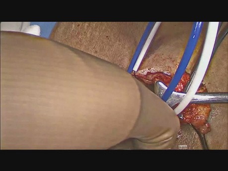 Plastische Chirurgie von Nabelhernie