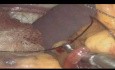 Laparoskopische Splenektomie bei Metastasen in der Milz