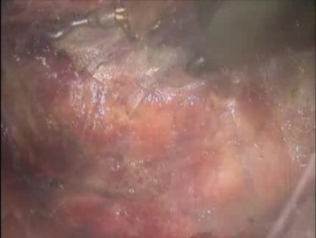 Robotische totale mesorektale Exzision – praktische Lösung (fettleibige Patientin)