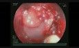Endoskopische Vollwandresektion (FTR) eines restlichen rektalen Adenom mit signifikanter Fibrose