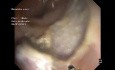 ESD (Endoskopische Submukosadissektion) + Klippung des Resektionsbettes
