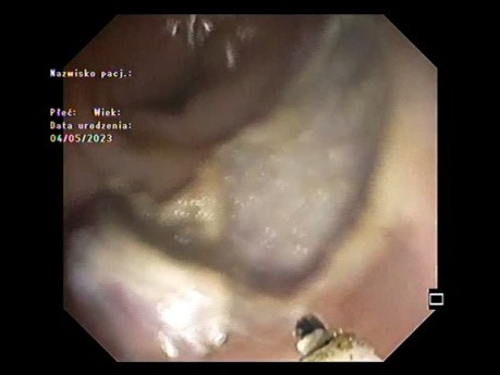 ESD (Endoskopische Submukosadissektion) + Klippung des Resektionsbettes