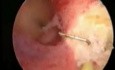 Uterus septus- hysteroskopische Resektion