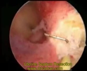 Uterus septus- hysteroskopische Resektion
