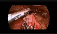 Laparoskopische Reparatur der Magenperforation