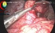 Komplizierte Appendizitis – Reduktion und chirurgisches Vorgehen