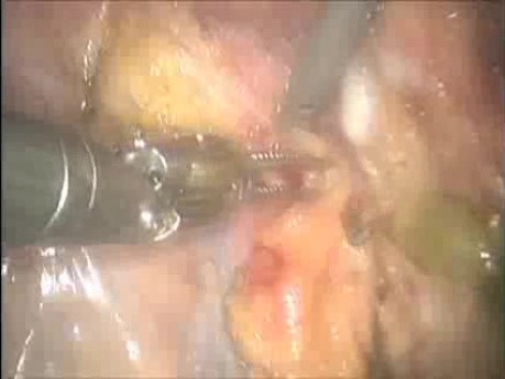 Intersphinkterische Dissektion, gefolgt von robotergestützter abdominoperinealer Resektion bei anteriorem Rektumkarzinom