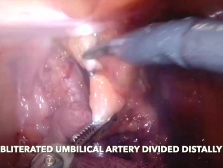 Roboter-assistierte abdominoperineale Rektumexstirpation – Erweiterte TME