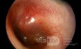 Akute Otitis media