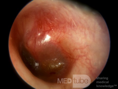 Akute Otitis media