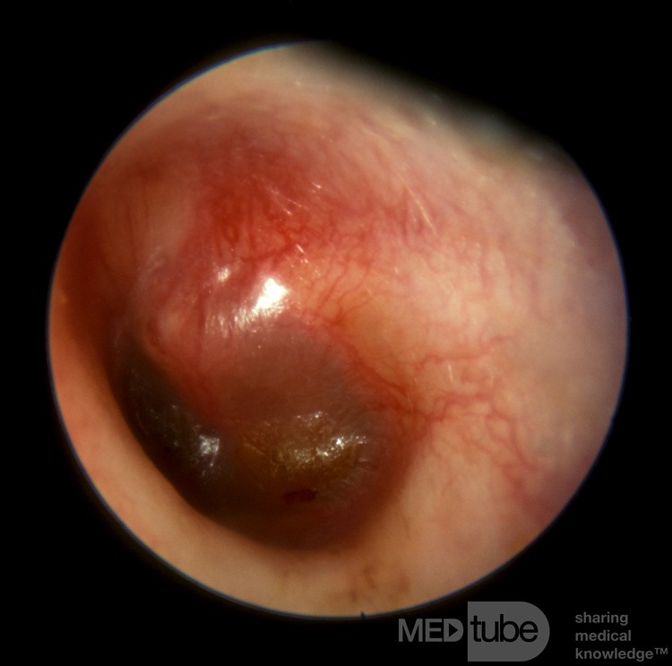 Akute Otitis media