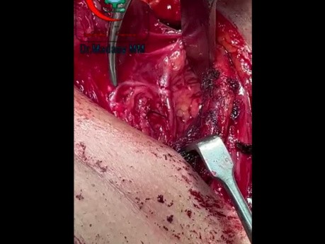 Extralaryngeale Verzweigung des rekurrenten Larynxnervs