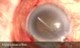 Spontan aufgetretenes malignes Glaukom während der Phakotrabekulektomie