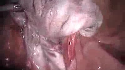 Laparoskopische Ovarialzystektomie