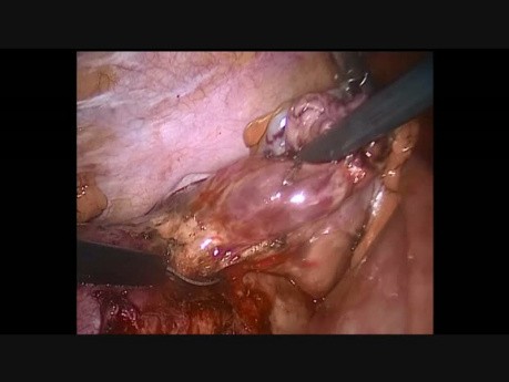 Laparoskopie in der Schwangerschaft 