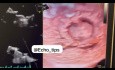 Prospektive 3D-transösophageale Echokardiographie (TEE) der Mitralklappe und des linken Vorhofs